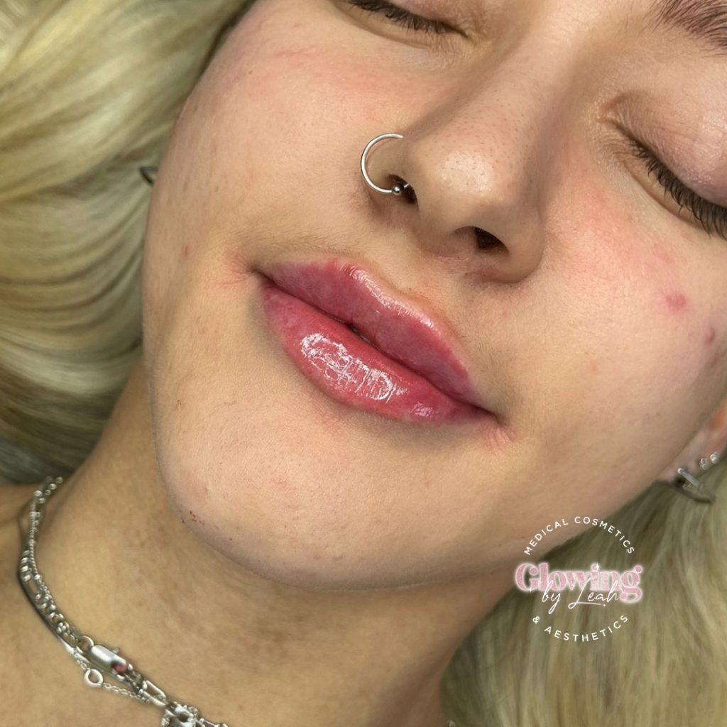 Client happy with lip fillers