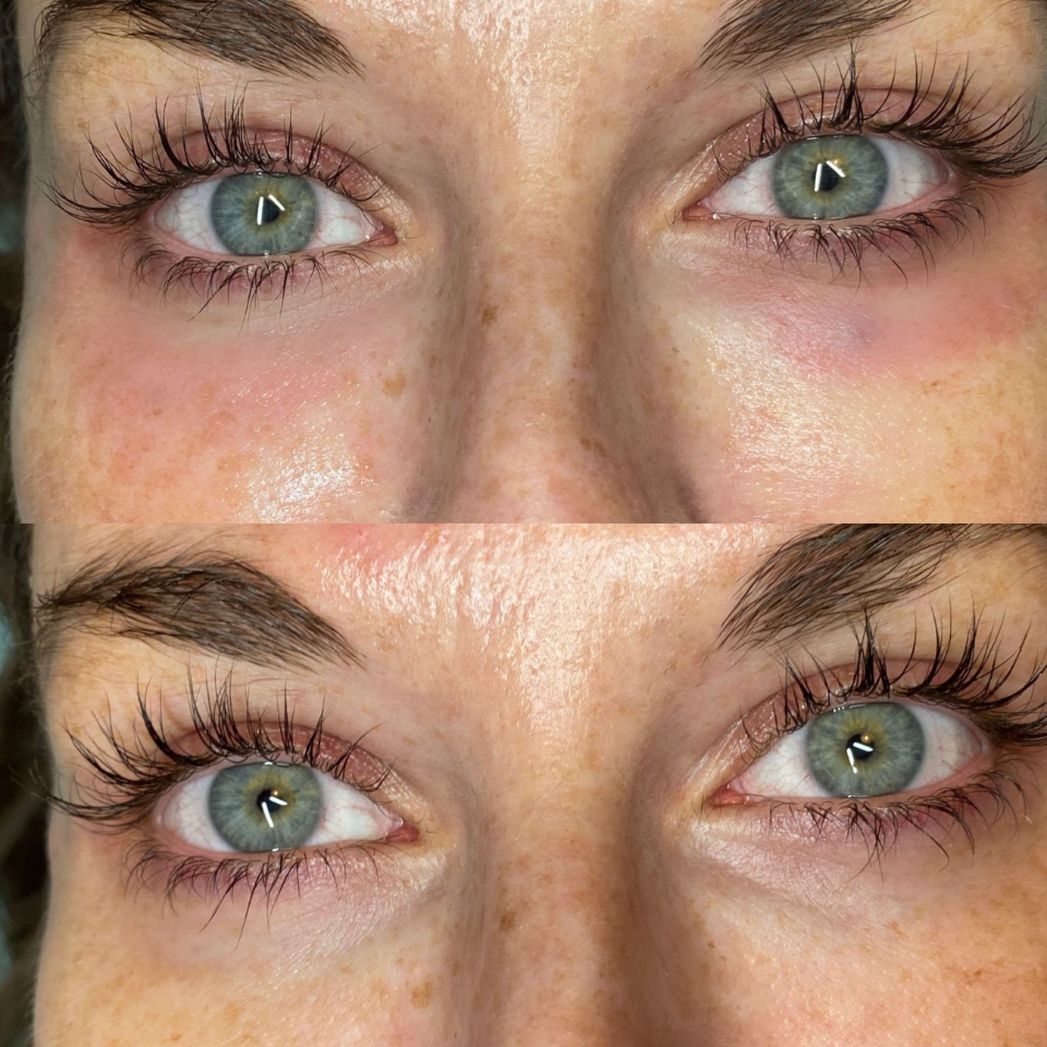 Polynucleotides under eye results before and after
