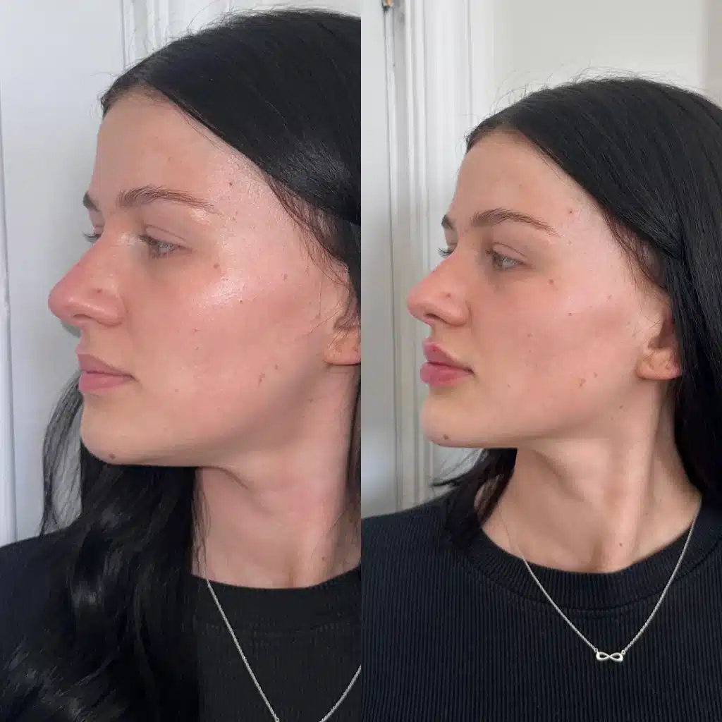 Side profile improved after fillers