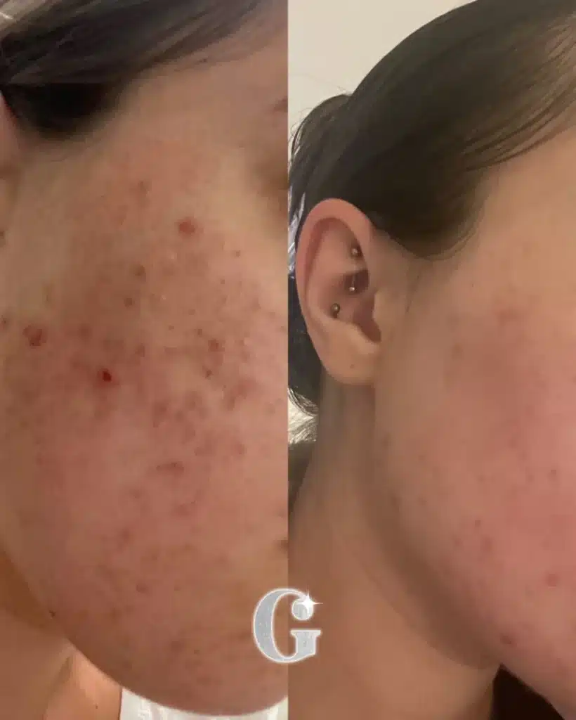 advanced skin treatment