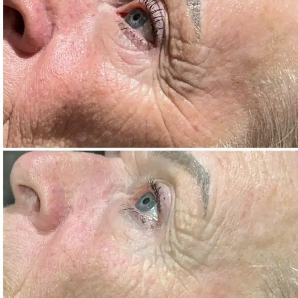 Wrinkle rejuvenation LED treatment