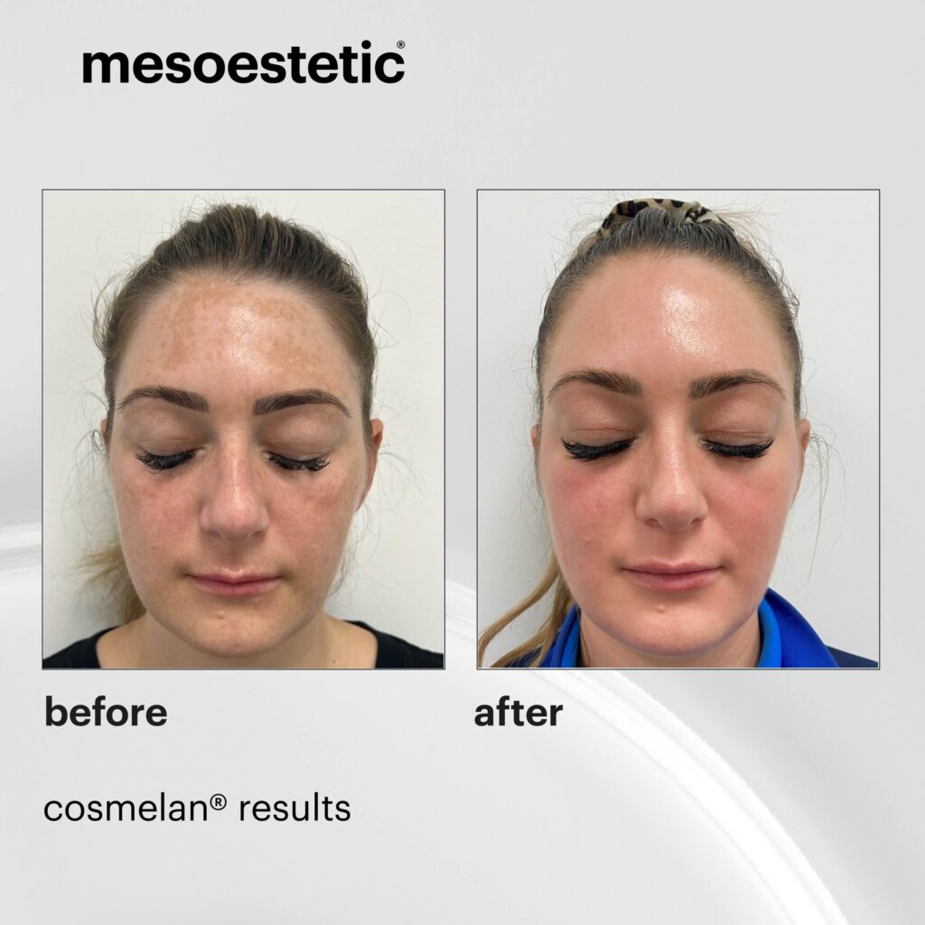 advanced chemical peel results