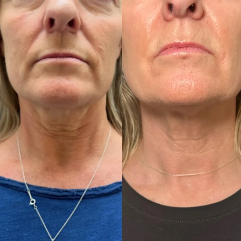 Neck treatment