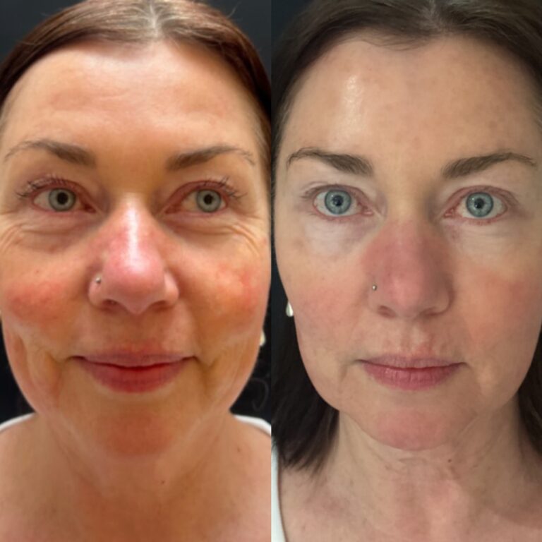 Rejuvenation treatment