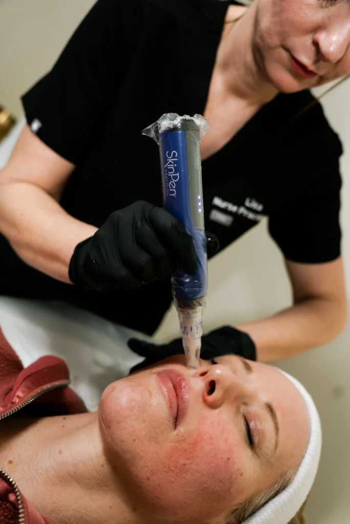 Microneedling at Glowing By Leah