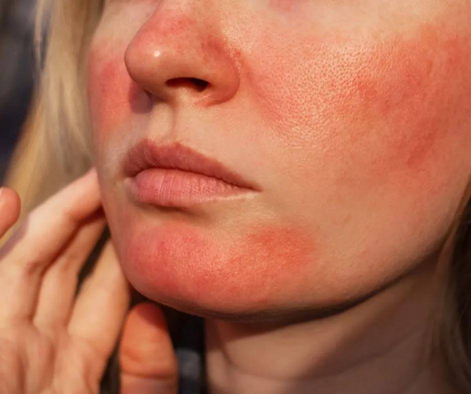 Rosacea skin