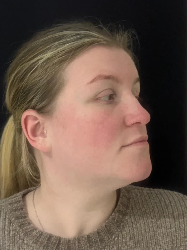 Skin improvement from Dermalux LED Therapy at Glowing By Leah