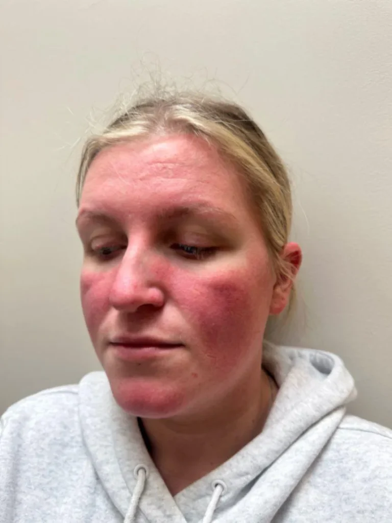 Skin Redness before Dermalux LED Therapy at Glowing By Leah