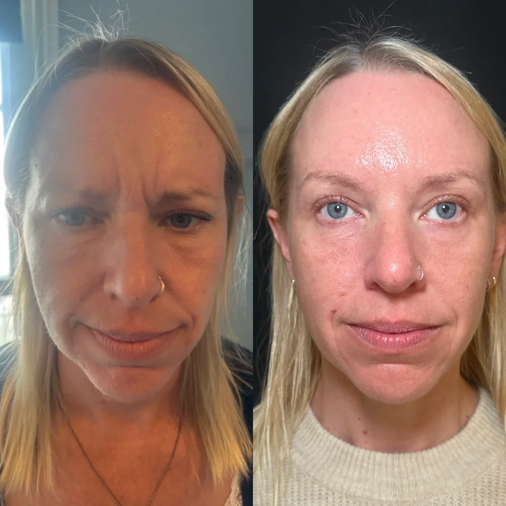sculptra, filler in nasolabial periform and toxin. Before and after.