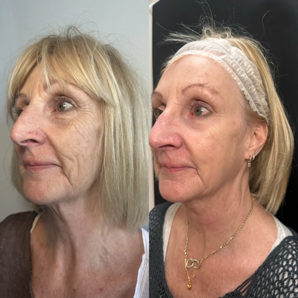 sculptra, polys and skin boosters for eyes and face. Before and after